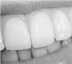 Blanchiment dentaire